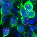 Winzige Ablagerungen von Alpha-Synuclein in dopaminbildenden Nervenzellen: Solche frühen Proteinveränderungen könnten bei Parkinson wichtige Transportwege blockieren und die Zellreinigung stören. © Tofaris Group