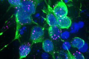 Winzige Ablagerungen von Alpha-Synuclein in dopaminbildenden Nervenzellen: Solche frühen Proteinveränderungen könnten bei Parkinson wichtige Transportwege blockieren und die Zellreinigung stören. © Tofaris Group