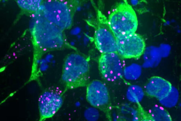 Winzige Ablagerungen von Alpha-Synuclein in dopaminbildenden Nervenzellen: Solche frühen Proteinveränderungen könnten bei Parkinson wichtige Transportwege blockieren und die Zellreinigung stören. © Tofaris Group