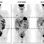 PET-Aufnahmen (Positronen-Emissions-Tomografie) eines Patienten zu drei Zeitpunkten zeigen ein sehr gutes Ansprechen auf das ADC Trastuzumab-Deruxtecan, das ungefähr 18 Monate angehalten hat. © NCT Heidelberg