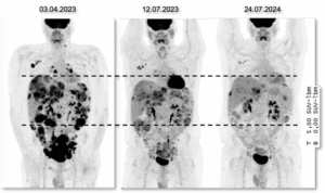 PET-Aufnahmen (Positronen-Emissions-Tomografie) eines Patienten zu drei Zeitpunkten zeigen ein sehr gutes Ansprechen auf das ADC Trastuzumab-Deruxtecan, das ungefähr 18 Monate angehalten hat. © NCT Heidelberg