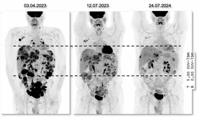 PET-Aufnahmen (Positronen-Emissions-Tomografie) eines Patienten zu drei Zeitpunkten zeigen ein sehr gutes Ansprechen auf das ADC Trastuzumab-Deruxtecan, das ungefähr 18 Monate angehalten hat. © NCT Heidelberg