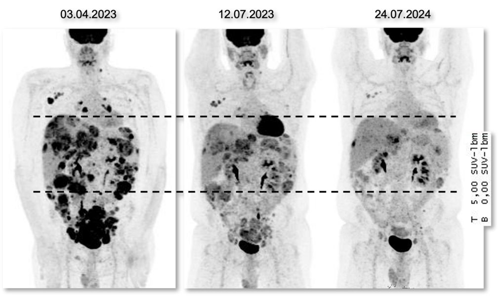 PET-Aufnahmen (Positronen-Emissions-Tomografie) eines Patienten zu drei Zeitpunkten zeigen ein sehr gutes Ansprechen auf das ADC Trastuzumab-Deruxtecan, das ungefähr 18 Monate angehalten hat. © NCT Heidelberg