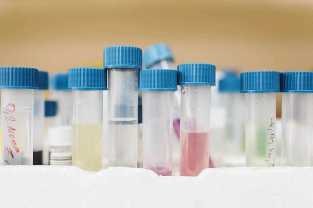 Ein Urintest könnte Blasenkrebs künftig deutlich einfacher erfassen: Statt nach Tumor-DNA sucht uRARE-seq nach RNA-Spuren, die zusätzlich etwas über das Verhalten des Tumors verraten.